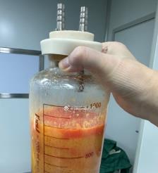 安达水动力吸脂手术要做多久？